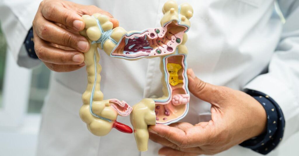 A doctor in a white jacket holds up a model of the large intestine, Anti-inflammatory Diet Vs Autoimmune Diet science